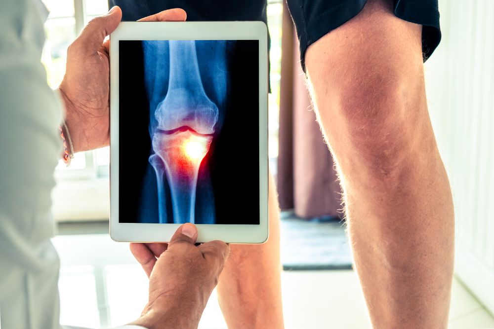 Osteoartróza: příčiny, příznaky a jak jí předcházet?